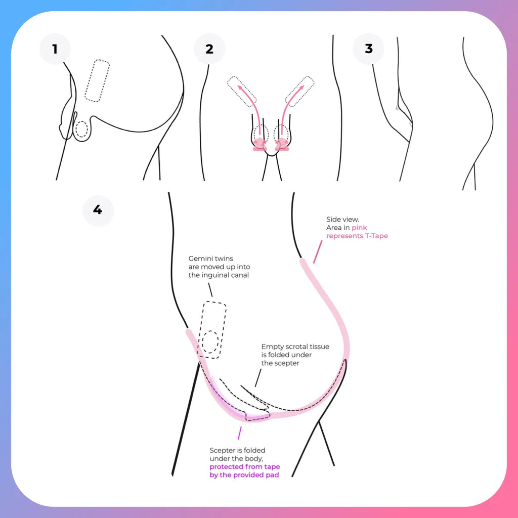 Genital Tucking for Trans-Feminine Patients